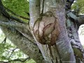 Gömbölyű daganat Gömbölyű daganat